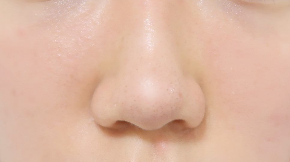 2차 코 봉오리 축소 코 조각 주사 후기교대역피부과 1개월 반 지났어 3