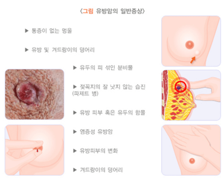 유방암 초기증상 검사비용 유방암 자가진단