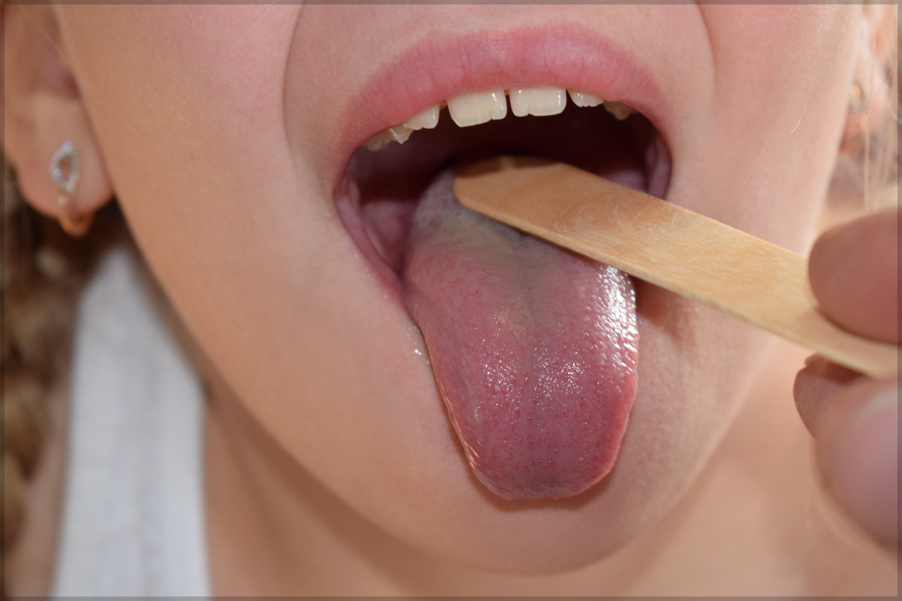 강 위생이 불량하거나 만성 편도염이 있는 경우에는 편도 결석이 반복적으로 생길 수 있습니다