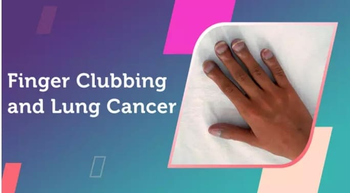  손가락이 붓고 손톱 모양이 변하면 폐암 가능성...이런 형상 나와야 정상 Finger Clubbing and Lung Cancer
