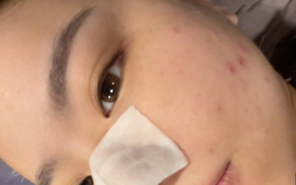 이마필러잘하는곳 후기! 19