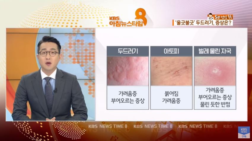  두드러기 원인 가라앉히는법
