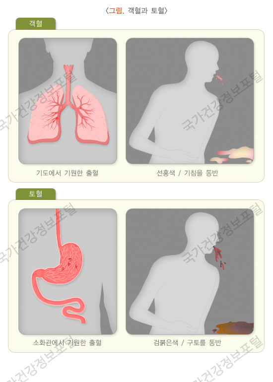  피를 토했어? 객혈, 토혈.