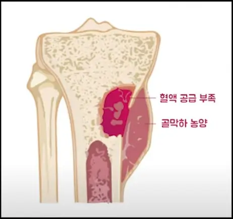 급성 골수염