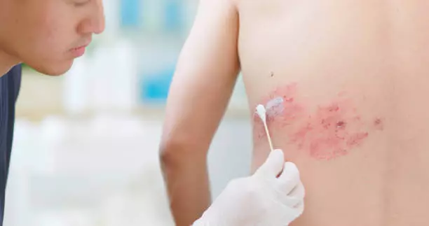 대상포진 초기증상 치료방법