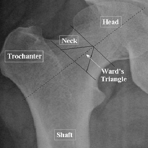 femur(대퇴골) xray