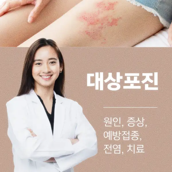 대상포진 원인, 증상, 예방접종, 전염, 치료