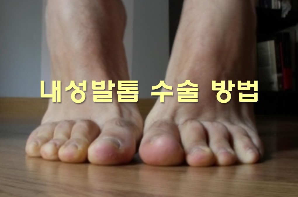 수원내성발톱치료와 관리방법, 시술비용, 보험청구 5