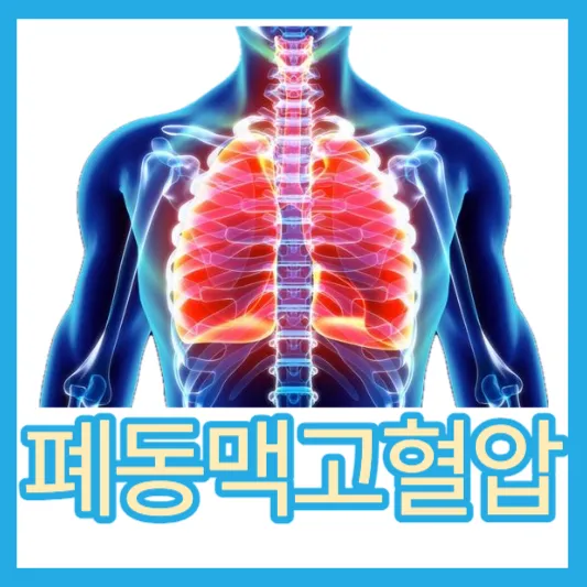 폐똥맥 돌연사 폐동맥고혈압 원인 증상 진단 검사 치료법