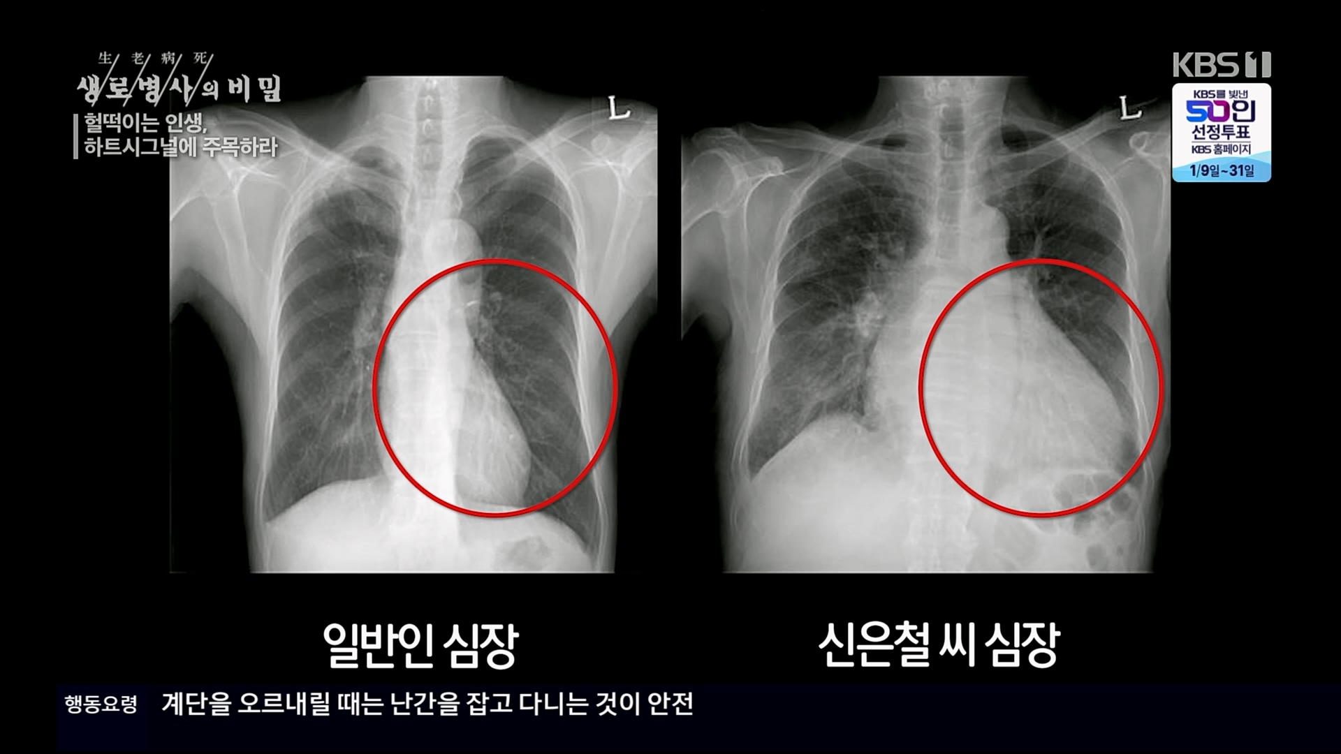 생로병사의 비밀.E853.230125p.H264-F1RST.mp4_20230210_203714.182.jpg