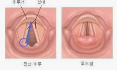 역류성 식도염 증상 잔기침