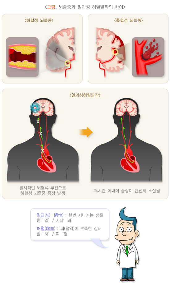  일과성 허혈 발작