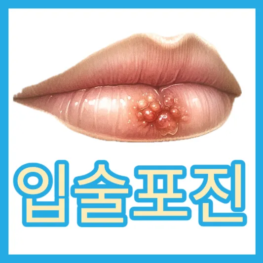 입술 포진 입술 물집 구순포진 약 입술 헤르페스 1형 원인 증상 연고 치료