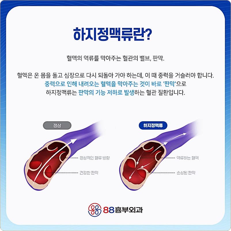 하지정맥류 수술비용 하지정맥류수술 비용 2