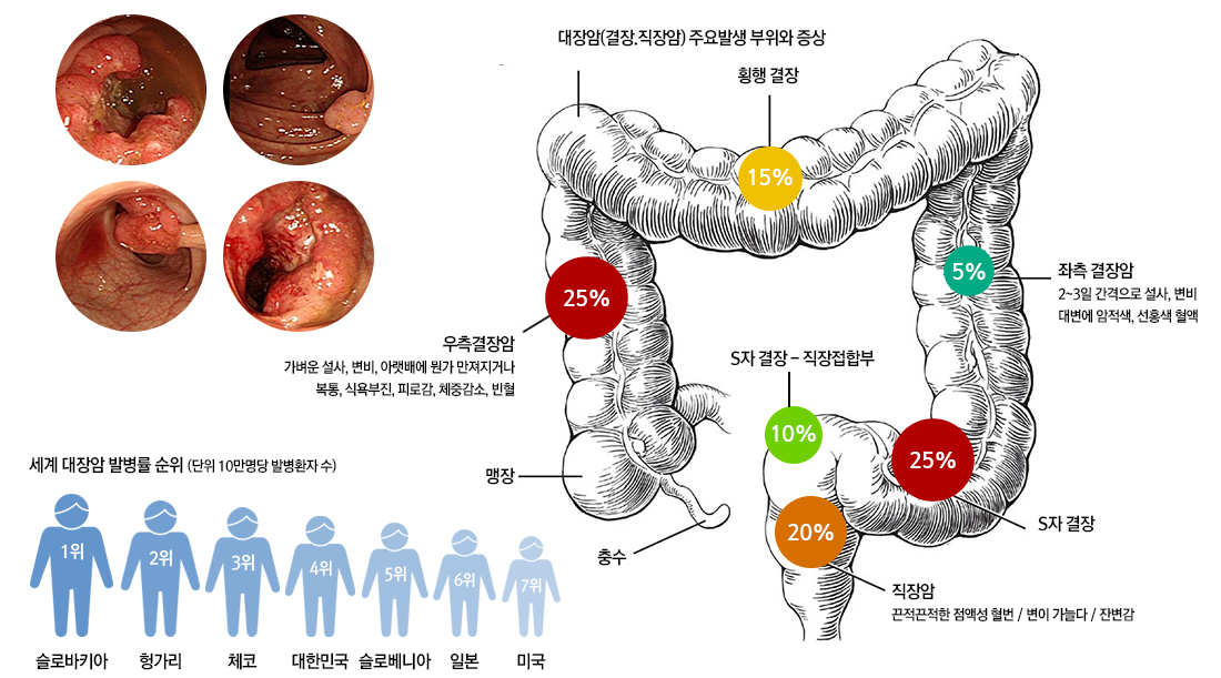 대장암의 정의, 원인, 증상과 진단 방법