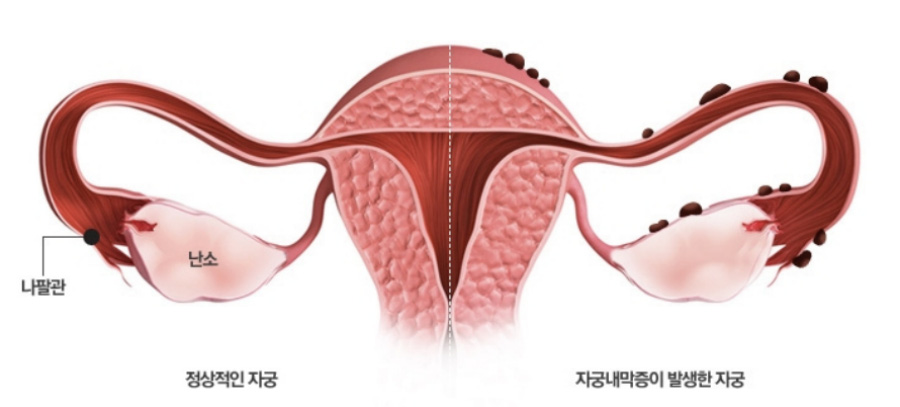 왼쪽에는 정상적인 자궁과 오른쪽에는 자궁내막증이 발생한 자궁을 비교하는 이미지 사진