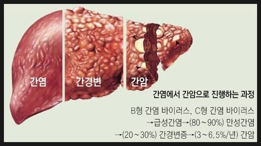 지방간 증상 및 비알콜성 지방간의 원인과 지방간에 좋은 음식 7가지