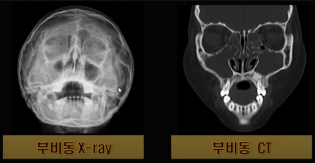 X-ray 또는 CT 촬영을 이용한 비염 검사