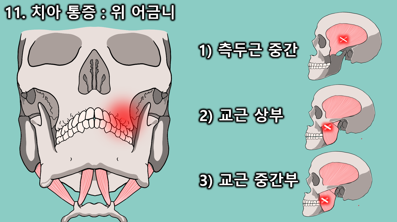 턱관절 근육통 통증유발점과 이비인후과 증상 총정리