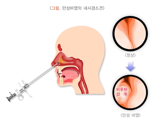 만성비염의-내시경-소견