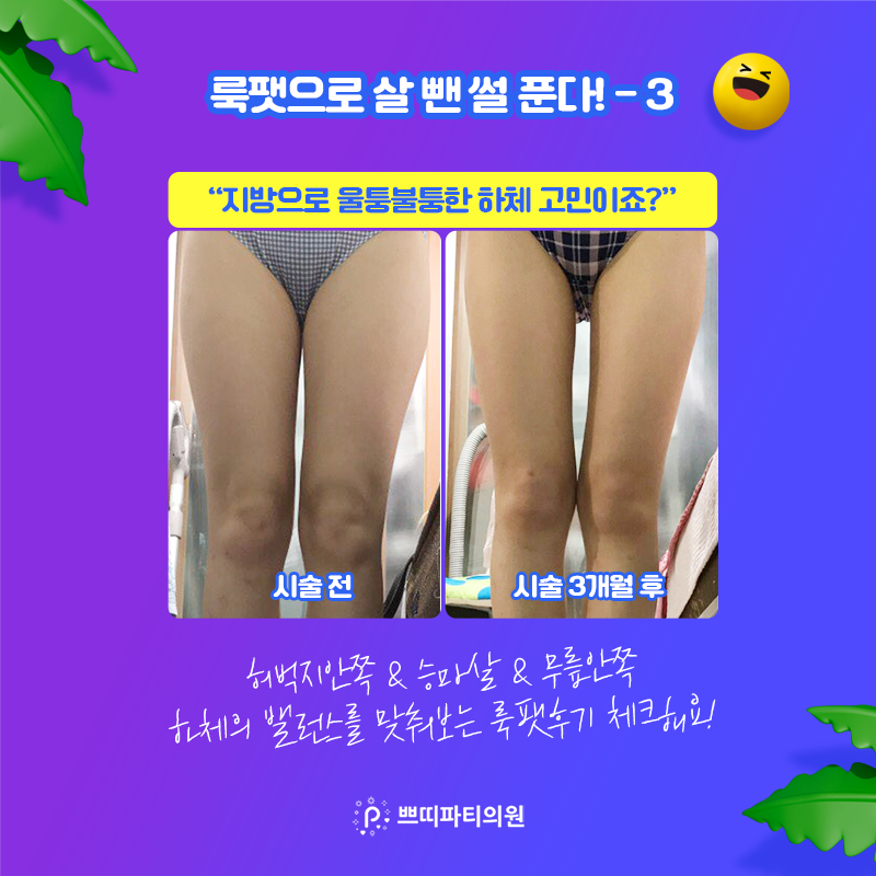  허벅지지방흡입가격 지방추출로도 괜찮을까? (룩팻후기&이벤트)