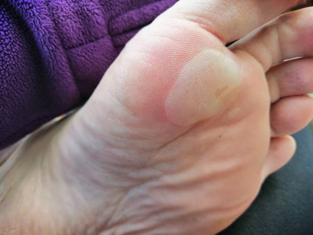 발바닥 통증의 원인 자세히 20