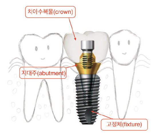 임플란트 뼈이식
