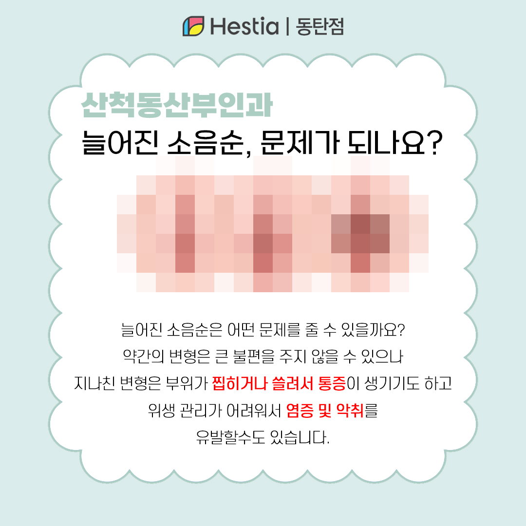 산척동산부인과 소음순성형사진 동탄 여의사 산부인과 늘어진 소음순, 왜 문제일까?