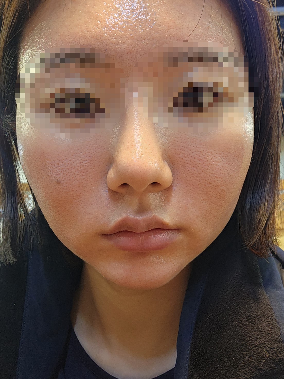 지루성&주사피부염&좁쌀의 브이빔 5차 1