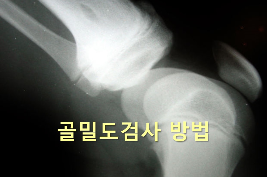  골다공증과 뼈의 밀도를 측정하는 골밀도검사 방법