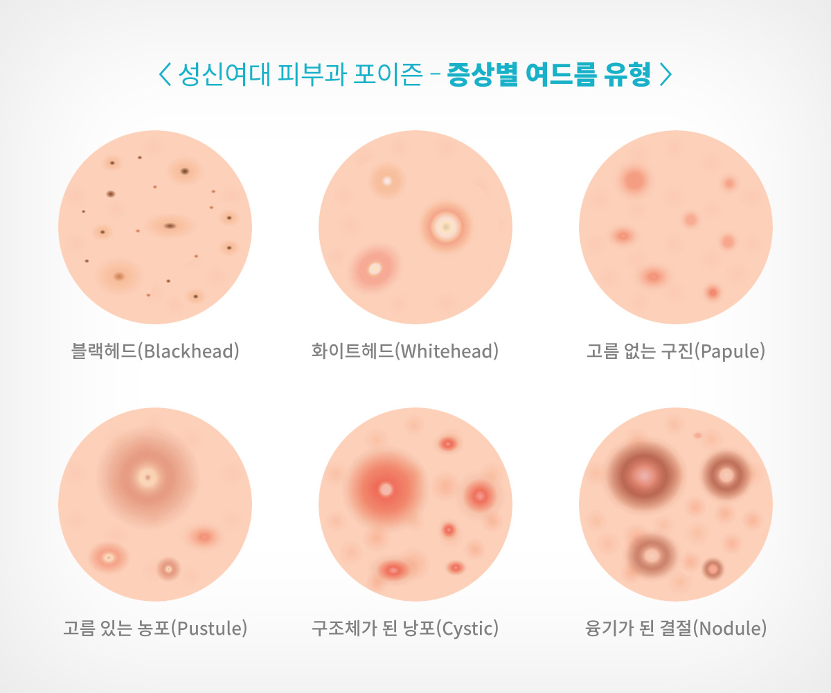  구진성,농포성,결절성,응괴성,켈로이드성 여드름