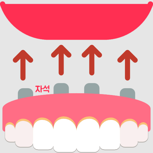 마그네틱 틀니