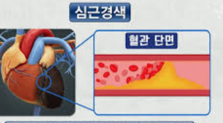 심근경색 전조 증상