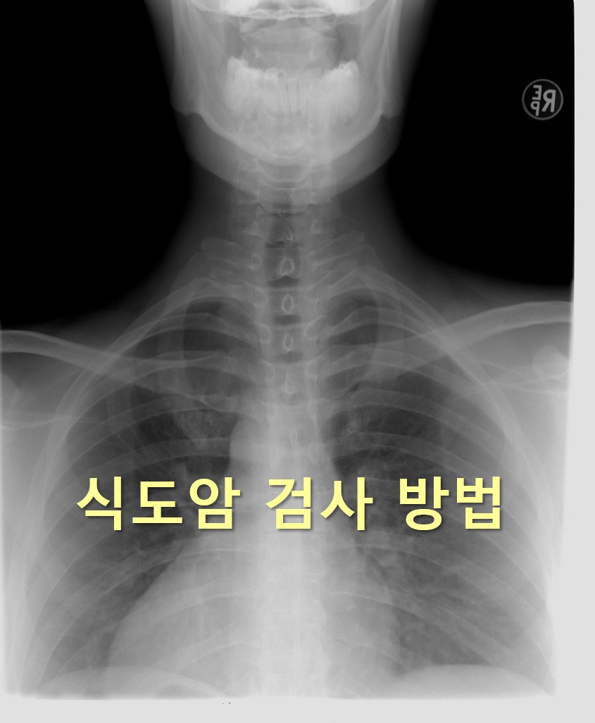  기관지 내시경과 초음파 내시경을 활용한 식도암 검사 방법