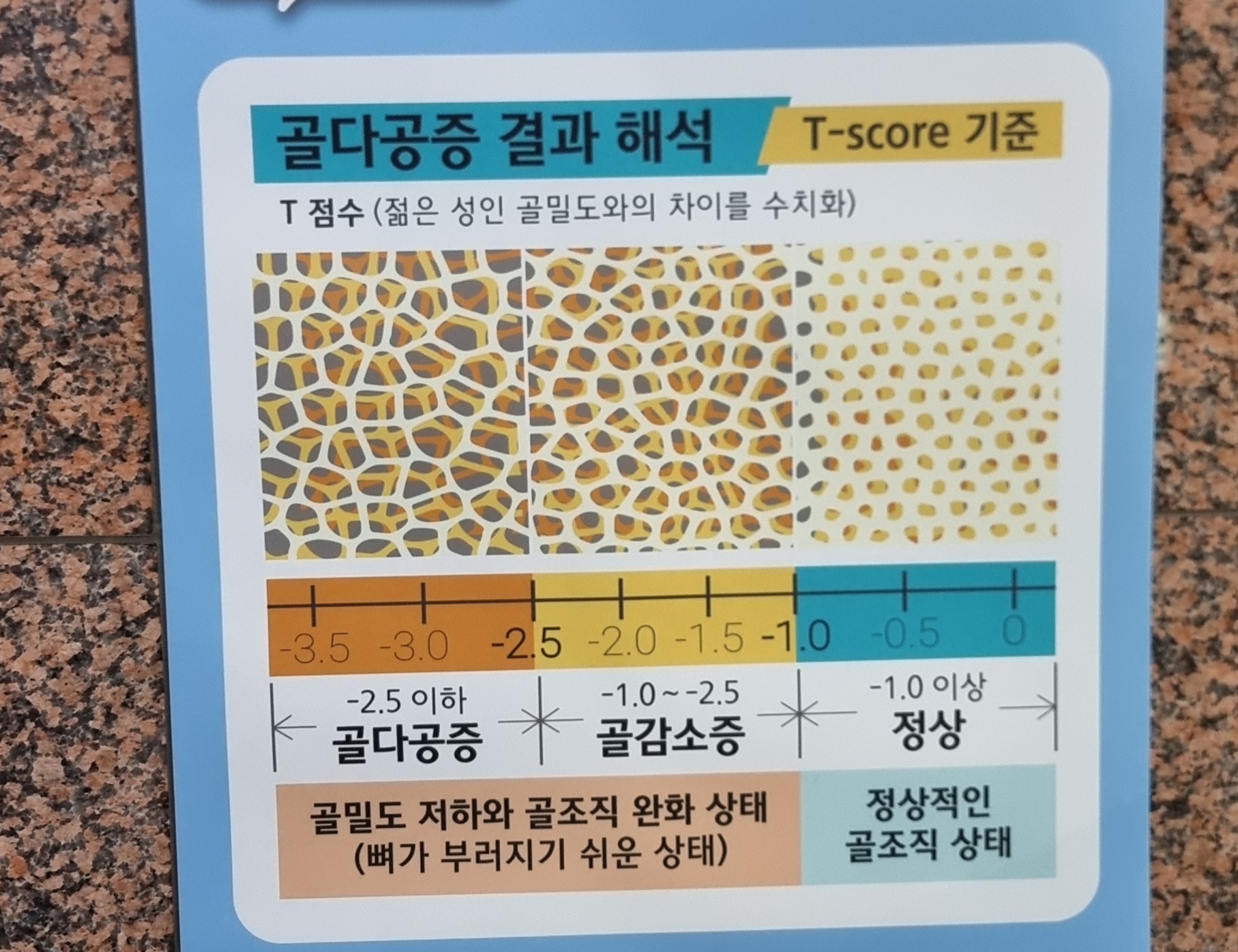 골다공증 검사 안내 사진