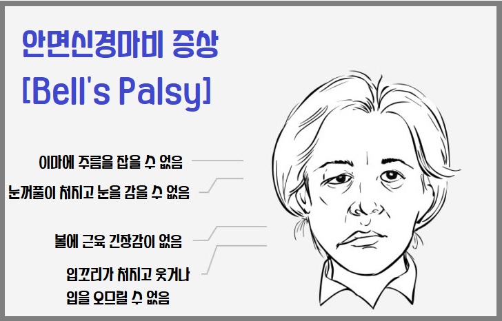 안면신경마비 증상