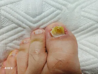 라셀턴 사용법과 가격 비교 발톱앰플 후기 정리해보기_2