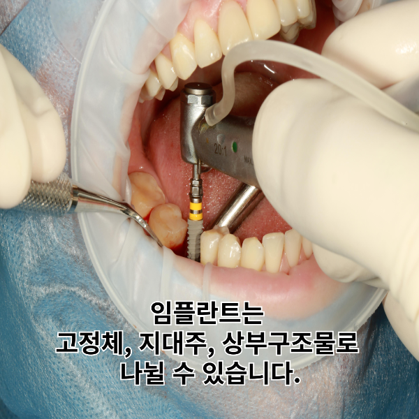 임플란트-시스템-썸네일