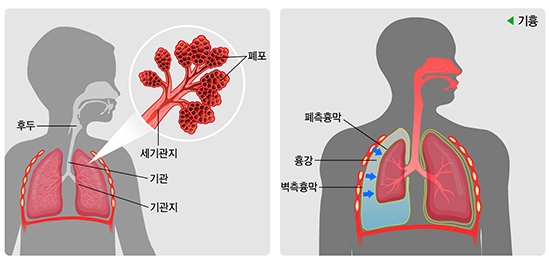 기흉