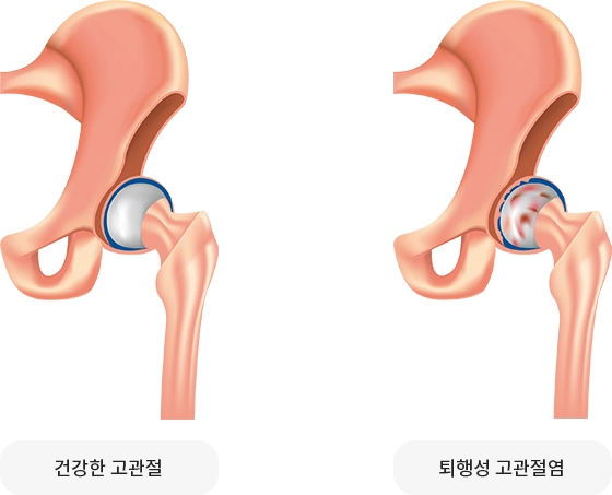 퇴행성고관절염1