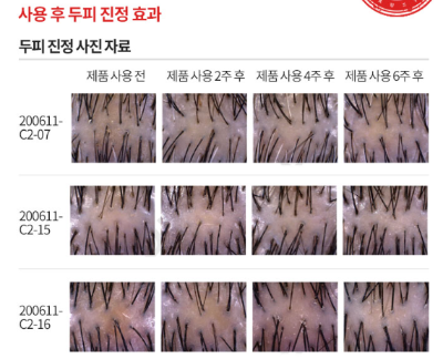 두피진정효과평가자료-KC피부임상연구센터