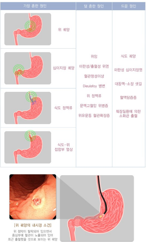  선홍색 혈변의 원인과 증상, 치료 방법