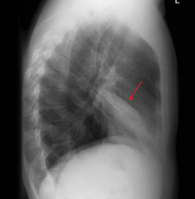 RML 무기폐 lateral view