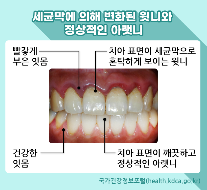 세균막에 의해 변화된 이빨