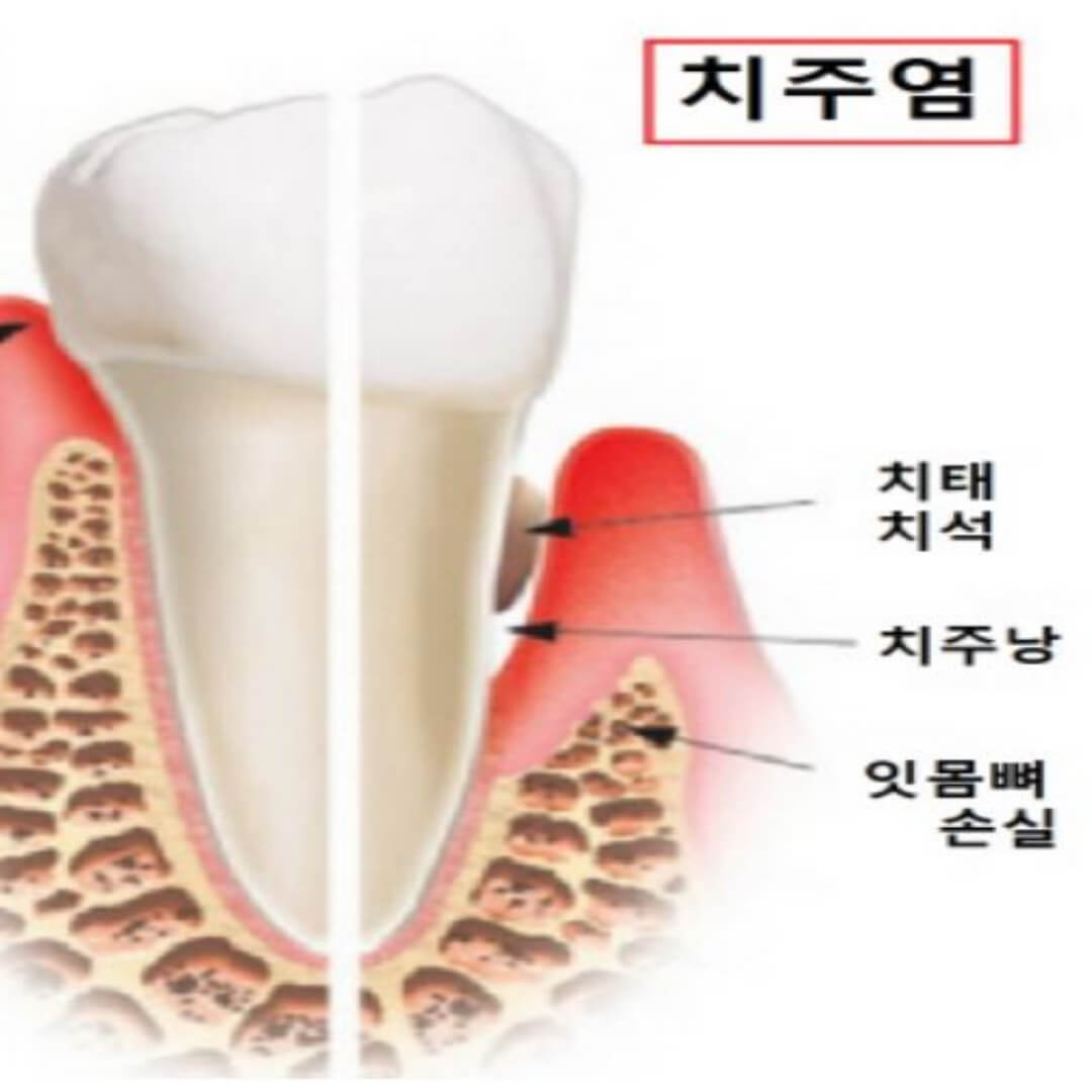 치주염
