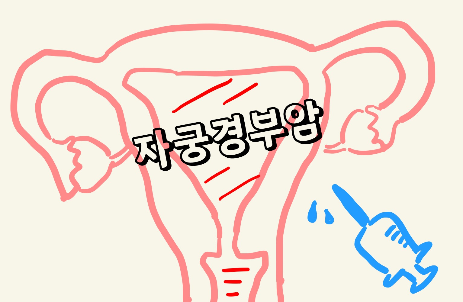 자궁의 해부학적 구조와 자궁경부암이 예방접종이 가능하단 점을 표현하기 위해 그려져 있는 주사