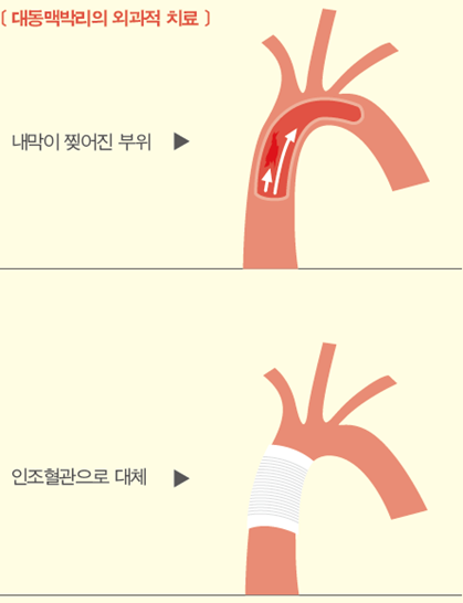 대동맥박리의 외과적 치료법을 나타낸 그림