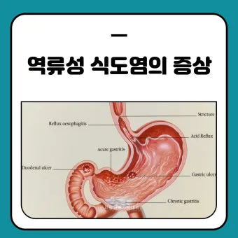 식도염에 좋은 음식 안좋은 음식_18