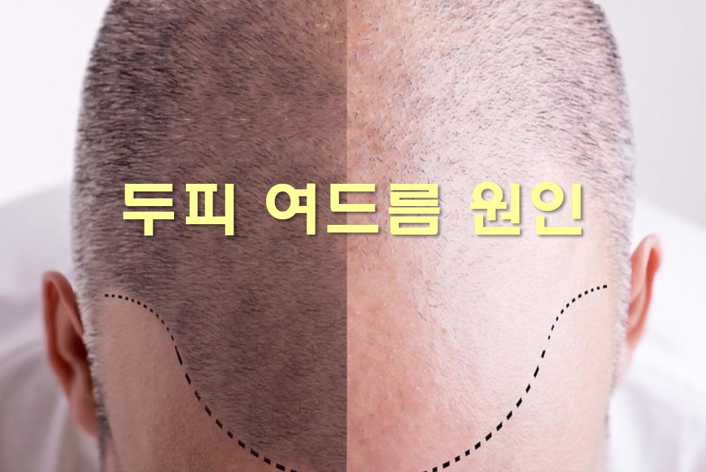  두피 여드름 원인과 두피 가려움증 원인
