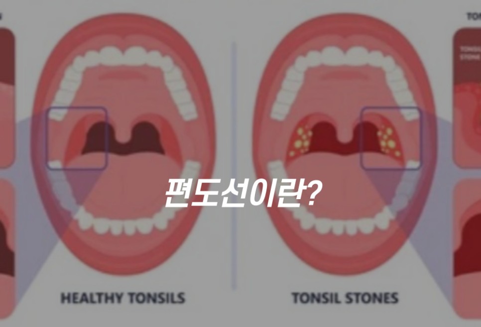 편도선 부었을 때 관리편도선이 붓는 이유와